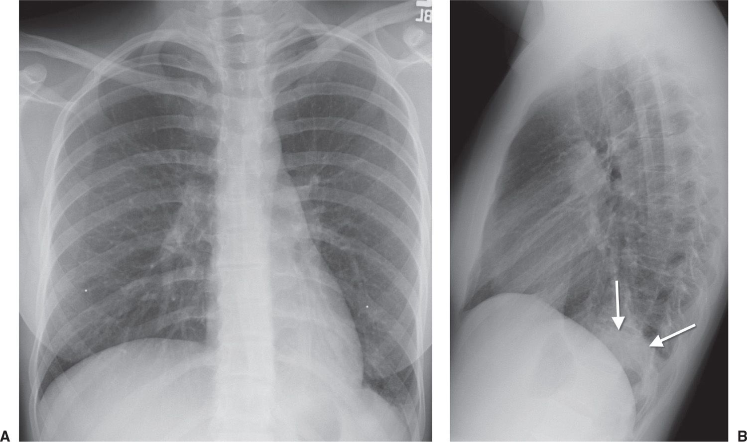 Left Upper Lung Pneumonia