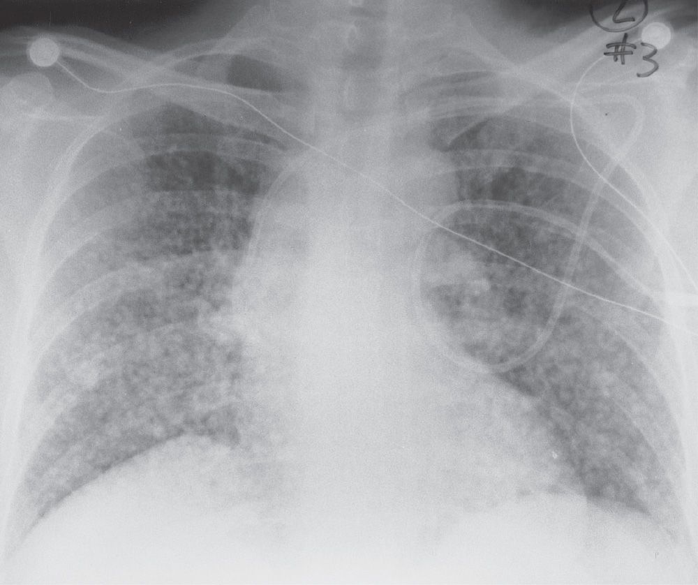 Interstitial Lung Disease X Ray