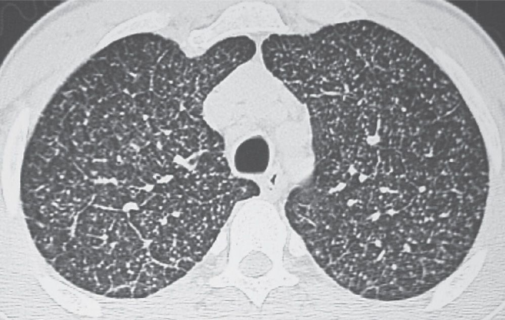 Interstitial Lung Disease | Radiology Key