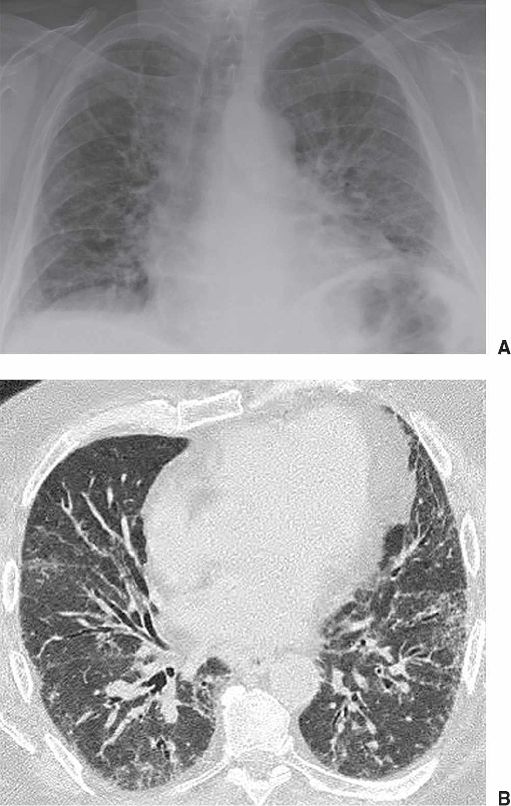 Interstitial Lung Disease | Radiology Key