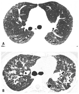 The Interstitial Pneumonias | Radiology Key