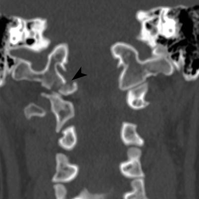 Imaging of Spinal Trauma | Radiology Key