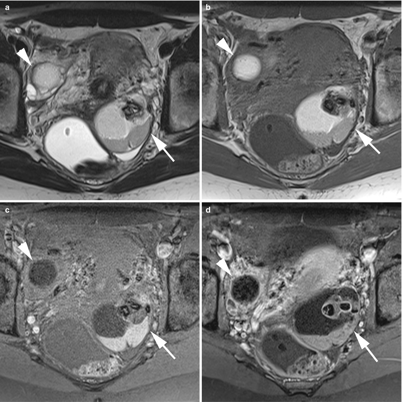 and MR of Benign Ovarian Germ Cell Tumours | Radiology Key