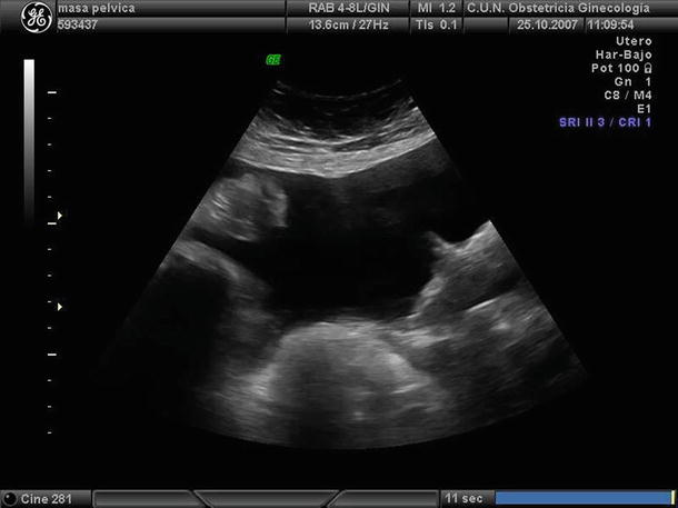 Ovarian Tumors (Serous/Mucinous/Endometrioid/Clear Cell Carcinoma ...