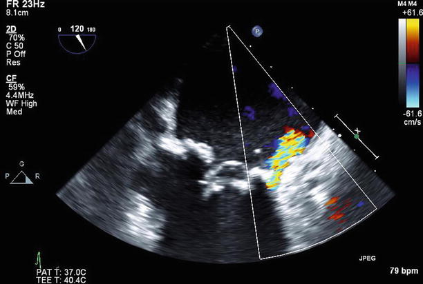 Mitral Valve Prostheses | Radiology Key