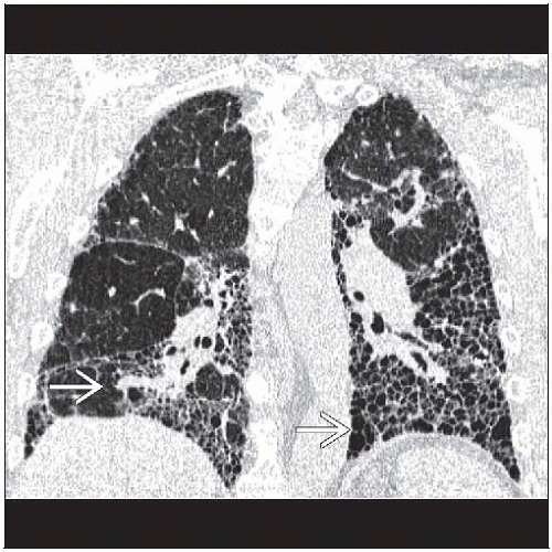 Idiopathic Pulmonary Fibrosis Honeycomb