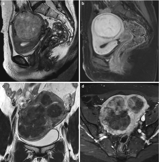 Fibroids | Radiology Key