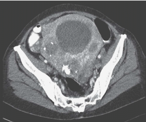 Uterine Diseases as related to Uterus - Pictures