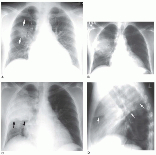 Chest X Ray Consolidation Vs Infiltrate