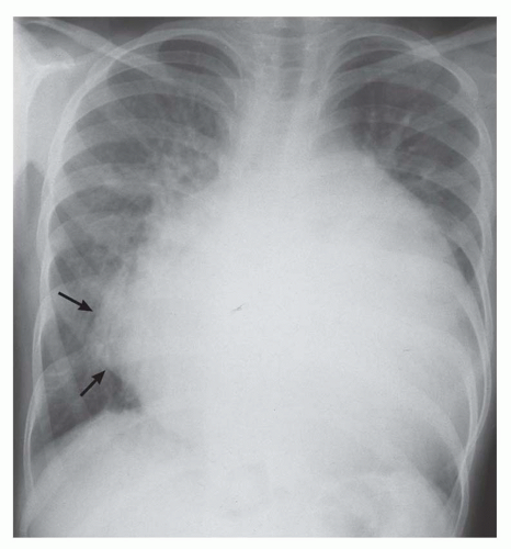 Radiography of Acquired Heart Disease | Radiology Key