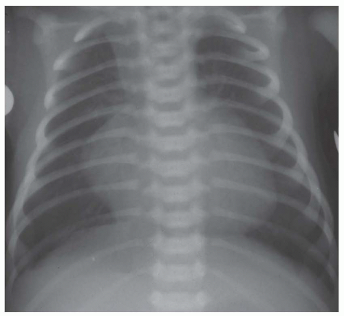 Radiography of Congenital Heart Disease | Radiology Key