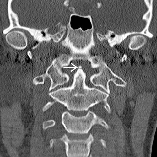 Ossiculum Terminale | Radiology Key