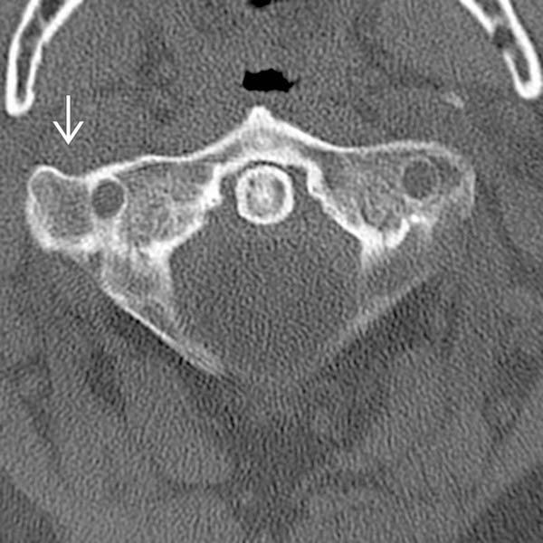 Paracondylar Process | Radiology Key