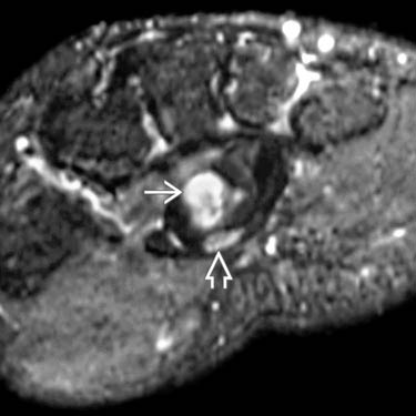 Median Neuropathy | Radiology Key