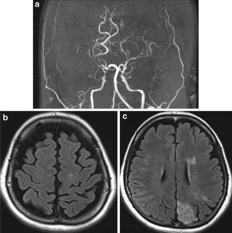 Moyamoya Disease (Spontaneous Occlusion of the Circle of Willis ...