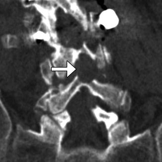 Imaging of Postoperative Spine | Radiology Key