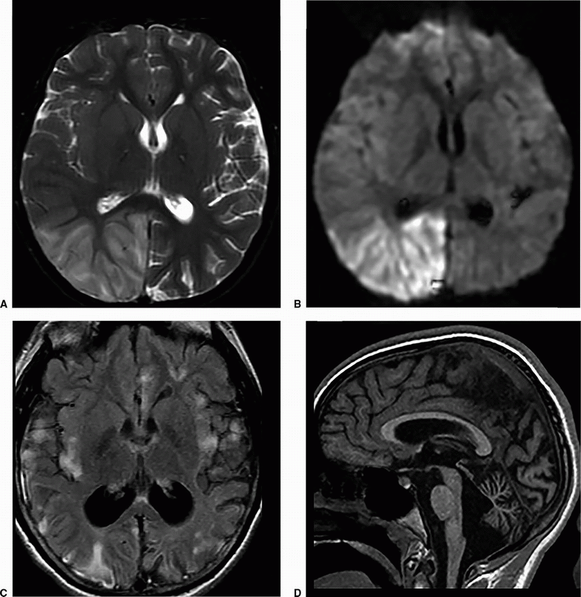 Inherited and Neurodegenerative Abnormalities | Radiology Key