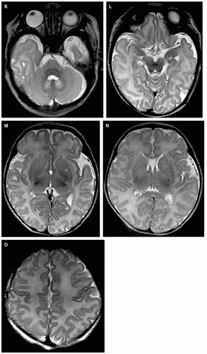 Normal Development of the Fetal, Neonatal, and Infant Brain, Skull, and ...