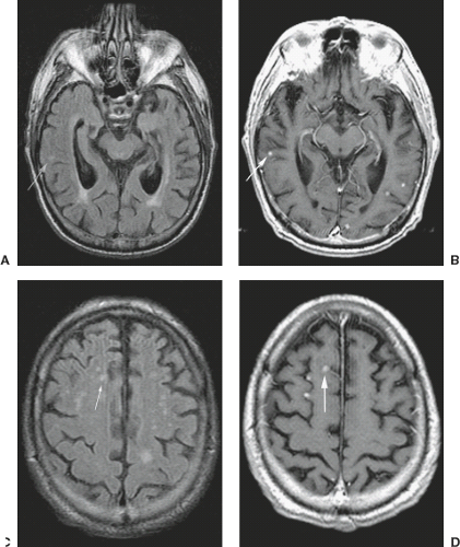 Adult Brain Tumors | Radiology Key