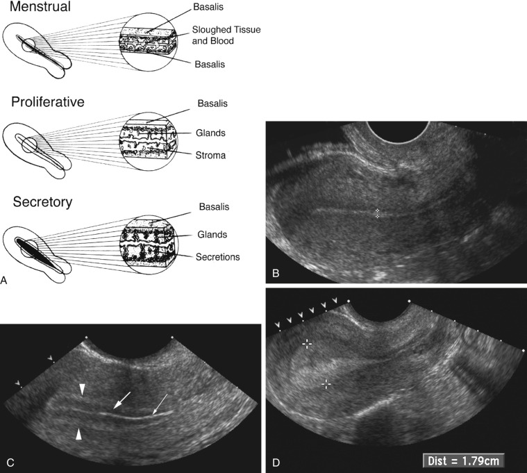 Ultrasound Evaluation of the Uterus (2023)