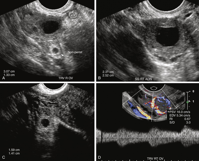 Ectopic Pregnancy | Radiology Key