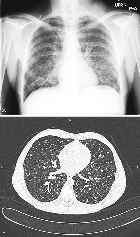 Diffuse Fine Nodular Opacities | Radiology Key