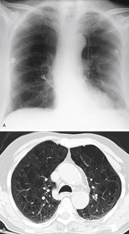 Hyperlucent Thorax | Radiology Key