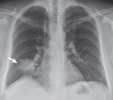 Consolidation Chest X Ray