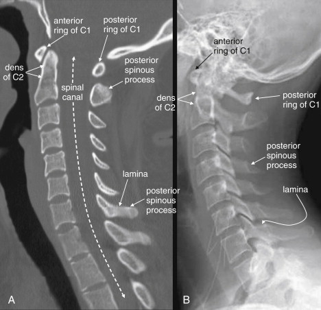 Imaging the Cervical, Thoracic, and Lumbar Spine - An Tâm