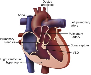 Tetralogy of Fallot | Radiology Key