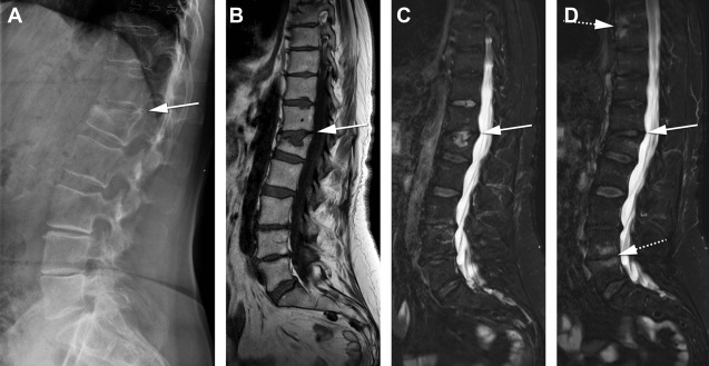 Radiographic/MR Imaging Correlation of Paravertebral Ossifications in ...