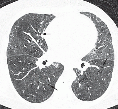 Diffuse Parenchymal Lung Diseases | Radiology Key