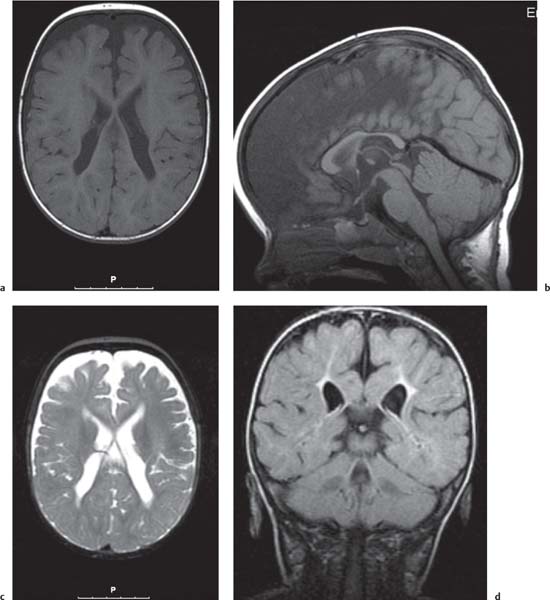 The Skull Base: Intracranial Abnormalities | Radiology Key