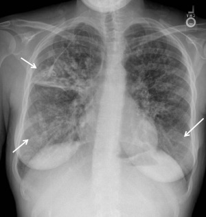 Cystic Fibrosis from Childhood to Adulthood | Radiology Key