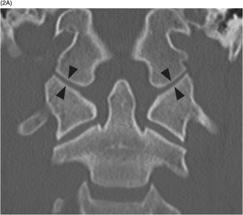 Section 5 – Specifics of Pediatric Spinal Trauma | Radiology Key