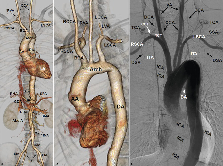 Aorta Anatomy