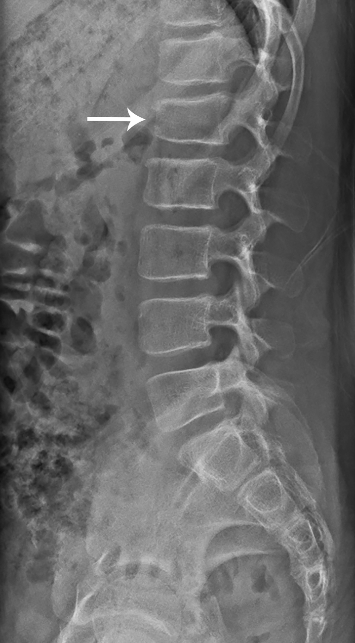 Vertebral Compression Fracture Nj Spine Center - vrogue.co