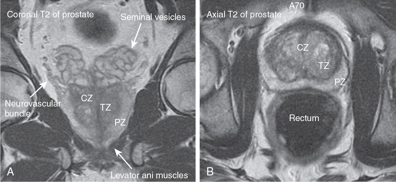 Prostate Zones Anatomy Anatomical Charts Posters - vrogue.co