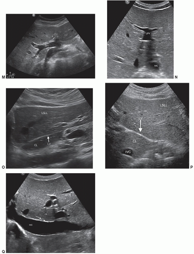 The Liver | Radiology Key