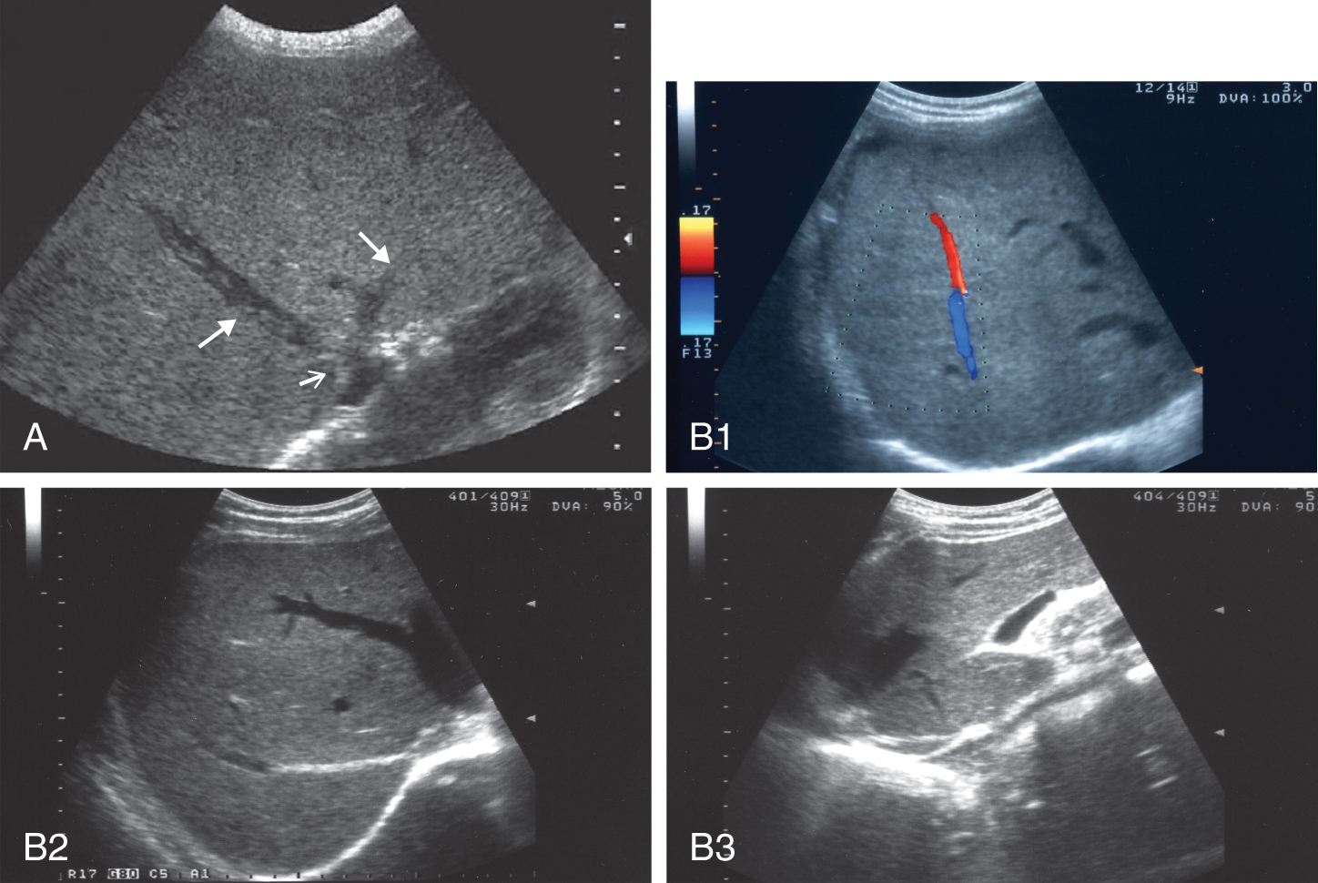 Normal Liver Ultrasound