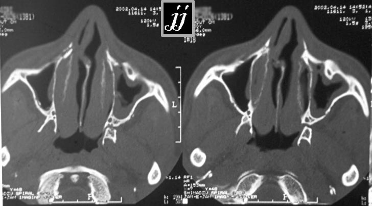 Radioogle | PNS – left maxillary sinus anterior wall fracture