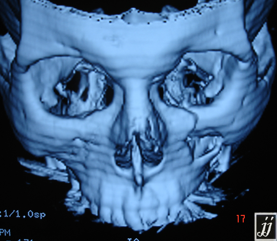 Radioogle | ENT- left maxillary sinus anterior wall fracture (2)