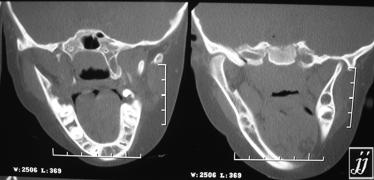 Radioogle | Orbit- left infra orbital fracture into left maxillary ...