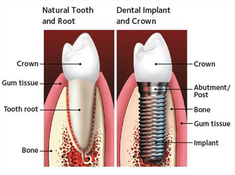 Step By Step Guide Divulging The Procedure of Dental Implant