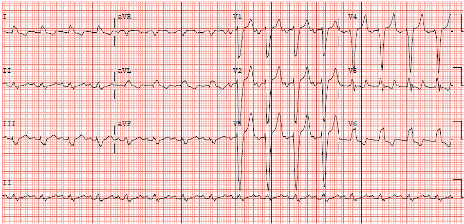 LBBB