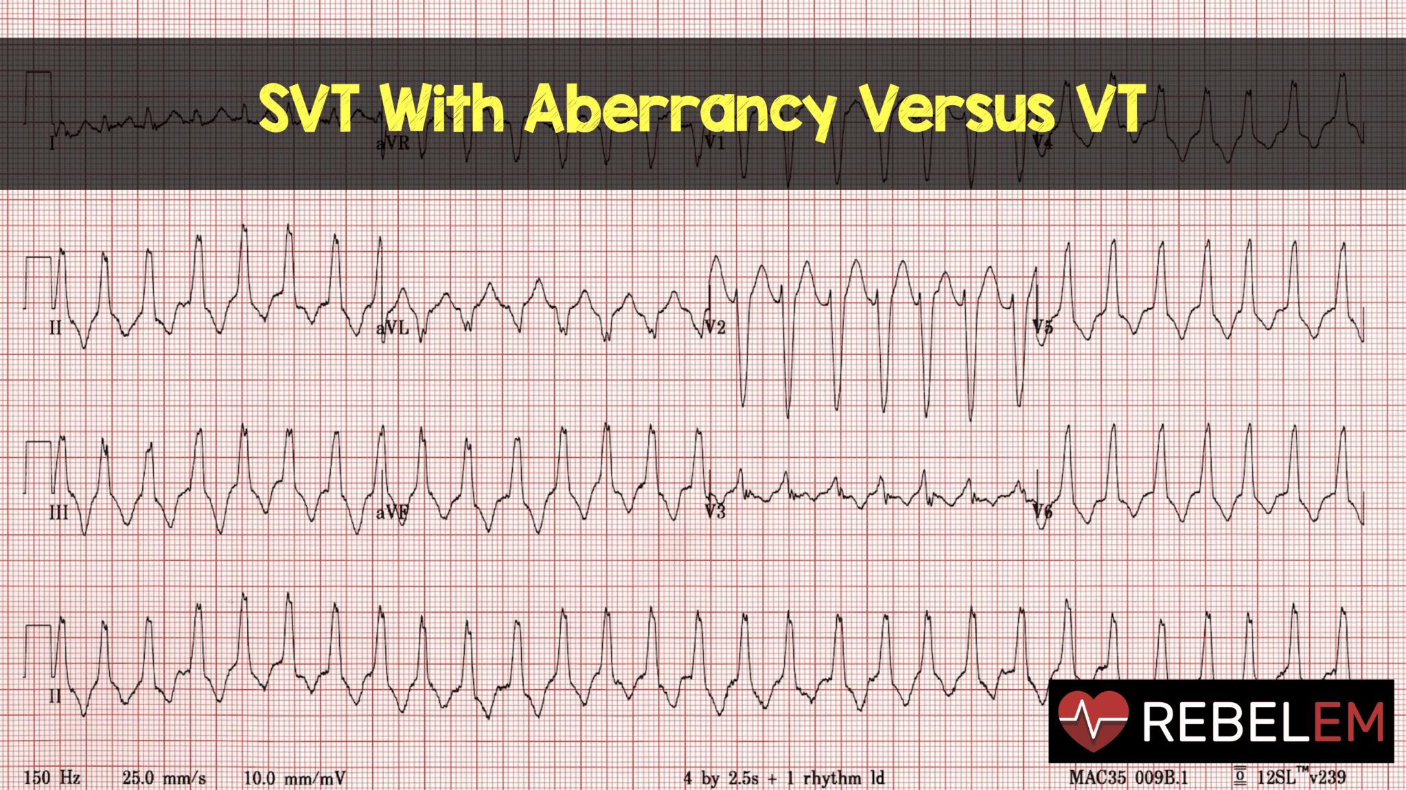 Ventricular Tachycardia Vs Supraventricular Tachycardia