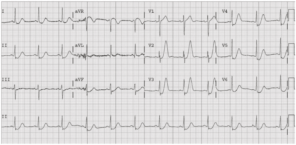 Five ECG Patterns You Must Know - REBEL EM - Emergency Medicine Blog