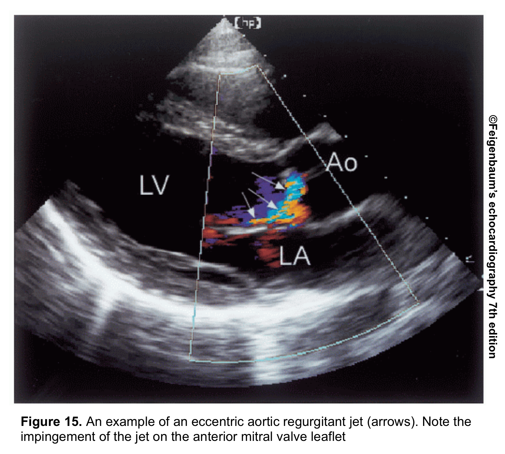 Valvular Emergencies Part 2: Diagnosis and Management of Severe Aortic ...