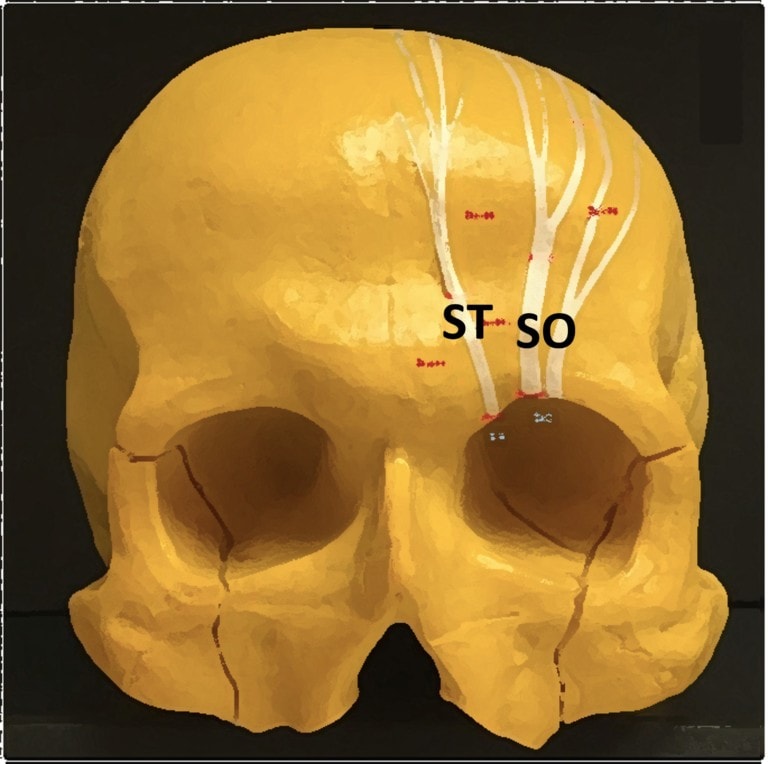 What Is a Proper Diagnostic Block Headache Work-up? - Regenexx