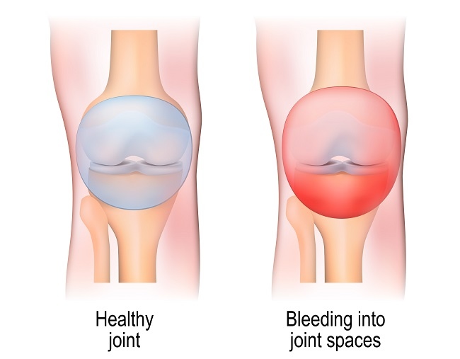 Hemarthrosis - Alodokter